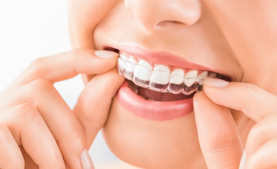 Patient holding an Invisalign clear aligner tray at Braswell Family Dentistry in Perry, GA