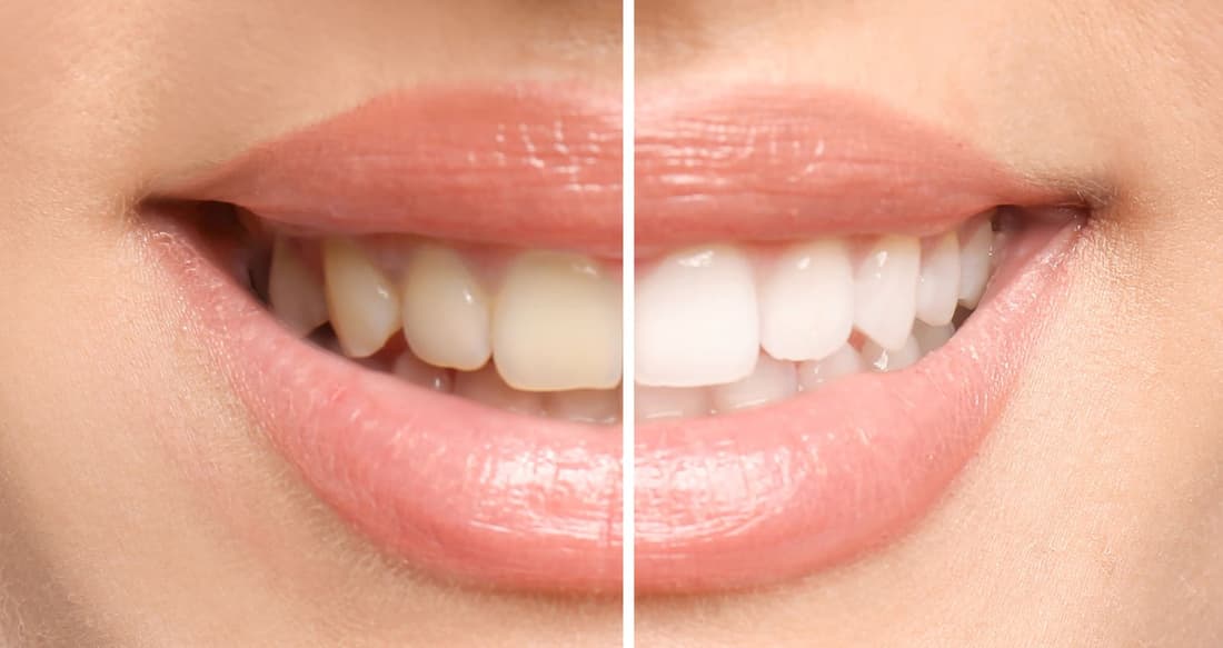 Before and after teeth whitening results at Braswell Family Dentistry in Perry, GA