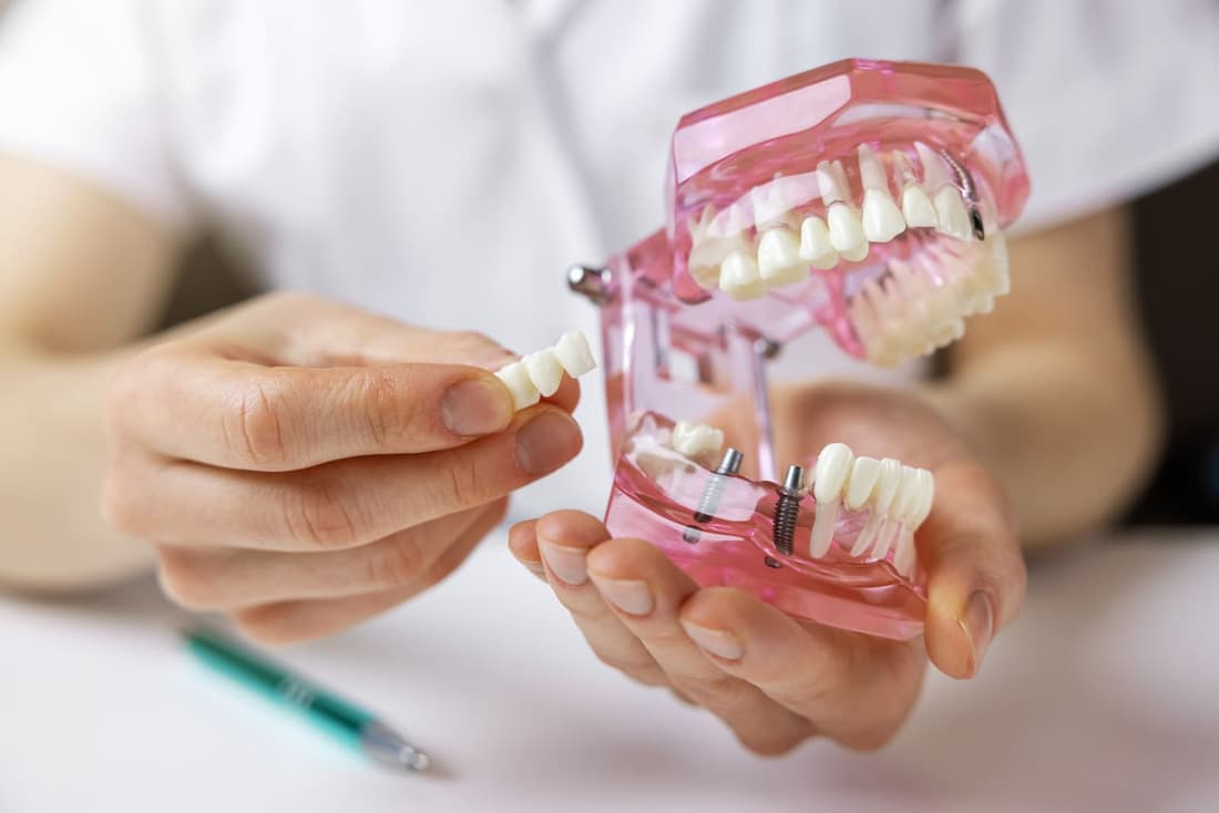 Dental bridge restoration at Braswell Family Dentistry in Perry, GA