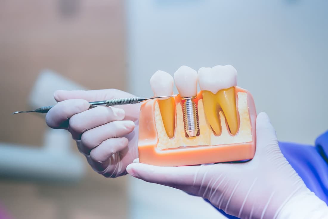 Dental implants at Braswell Family Dentistry in Perry, GA