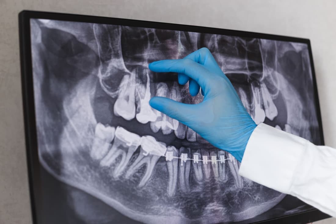 Root canal treatment at Braswell Family Dentistry in Perry, GA